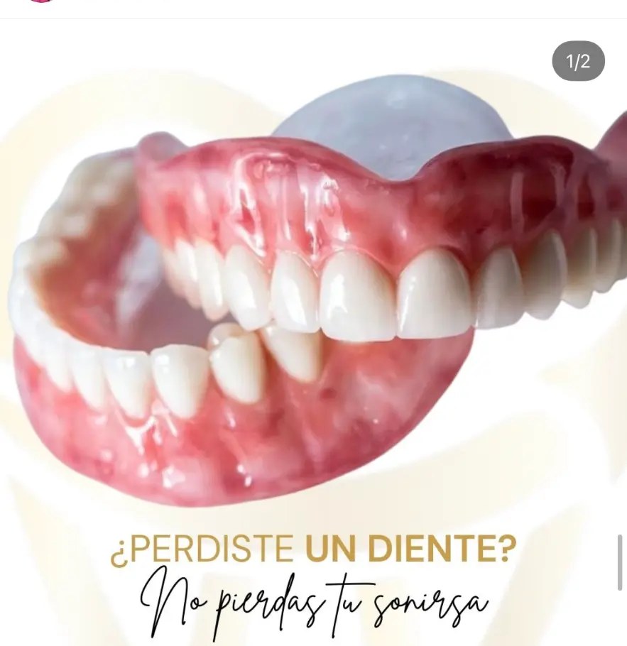 Modelo dental que ilustra el reemplazo de un diente perdido con implante